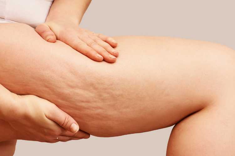 Cellulite - fonte_Canva - salernosera.it